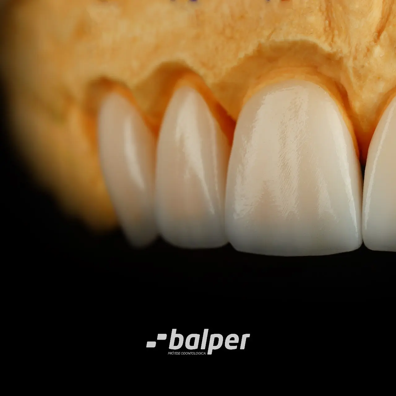 Facetas em E-MAX produzidas pela Balper